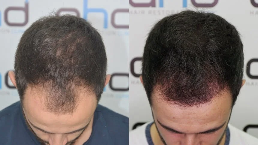 5-month top view hair transplant image