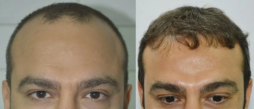The natural result of a hair transplant performed at AHD Clinic.